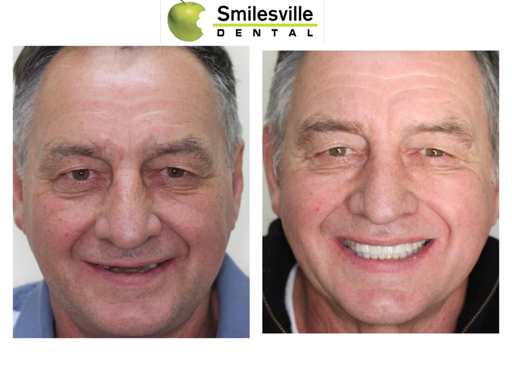Invisalign Treatment Christchurch