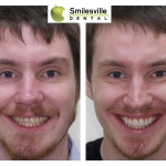 Veneers, crowns, bridges, implants and cosmetic fillings Smileville Dental Christchurch