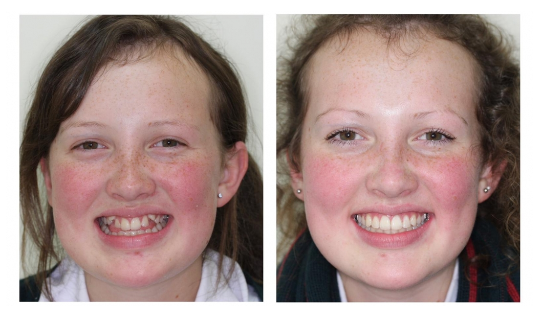 Invisalign treatment Christchurch. Orthodontic Invisalign Treatment