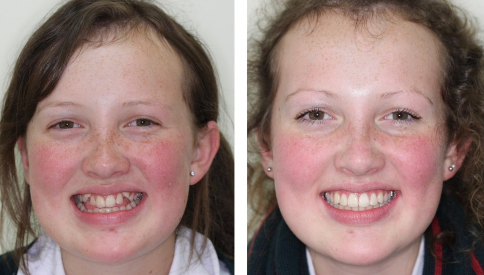 Invisalign treatment Christchurch. Smilesville Dental Riccarton Road Christchurch.